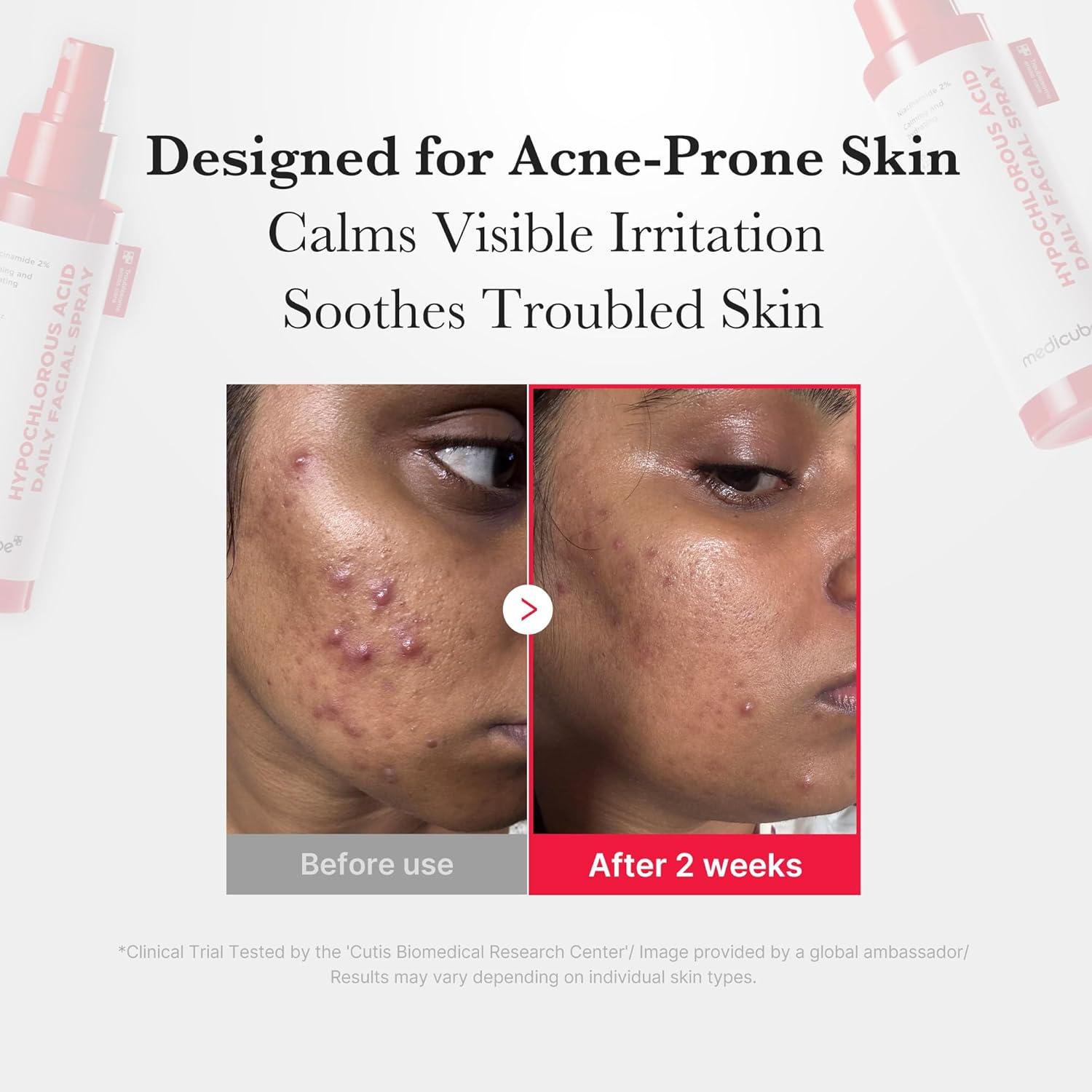 imagemedicube Power Soothing Spray Duo Hypochlorous Acid Full ampamp Mini Set for Instant Hydration and Soothing Care  Hypochlorous Acid Facial Mist Travel Size Gift Set 169 floz ampamp 422 floz